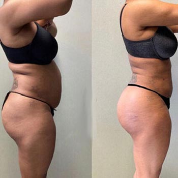 Before and After at Face Works Plastic Surgery, Plastic Surgeon in Schaumburg, IL