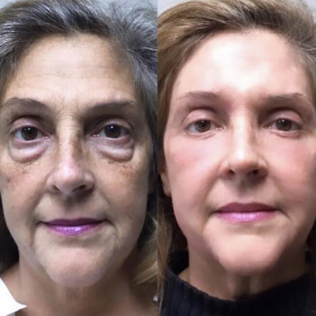 Before and After at Face Works Plastic Surgery, Plastic Surgeon in Schaumburg, IL