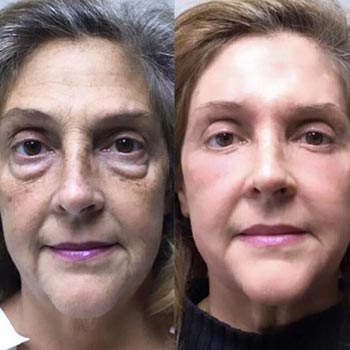 Before and After at Face Works Plastic Surgery, Plastic Surgeon in Schaumburg, IL
