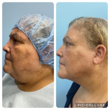 Before and After HD LipoX® of Jawline at Face Works Plastic Surgery, Plastic Surgeon Near Me in Schaumburg, IL Before and After HD LipoX® of Jawline at Face Works Plastic Surgery, Plastic Surgeon Near Me in Schaumburg, IL