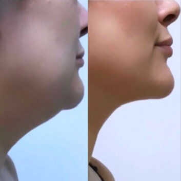 Before and After HD LipoX® of Jawline at Face Works Plastic Surgery, Plastic Surgeon Near Me in Schaumburg, IL Before and After HD LipoX® of Jawline at Face Works Plastic Surgery, Plastic Surgeon Near Me in Schaumburg, IL
