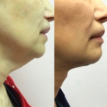 Before and After HD LipoX® of Jawline at Face Works Plastic Surgery, Plastic Surgeon Near Me in Schaumburg, IL Before and After HD LipoX® of Jawline at Face Works Plastic Surgery, Plastic Surgeon Near Me in Schaumburg, IL