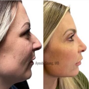 Before and After HD LipoX® of Jawline at Face Works Plastic Surgery, Plastic Surgeon Near Me in Schaumburg, IL Before and After HD LipoX® of Jawline at Face Works Plastic Surgery, Plastic Surgeon Near Me in Schaumburg, IL