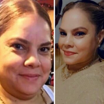 Before and After HD LipoX® of Jawline at Face Works Plastic Surgery, Plastic Surgeon Near Me in Schaumburg, IL Before and After HD LipoX® of Jawline at Face Works Plastic Surgery, Plastic Surgeon Near Me in Schaumburg, IL