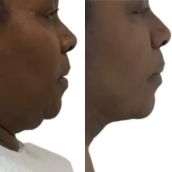 Before and After HD LipoX® of Jawline at Face Works Plastic Surgery, Plastic Surgeon Near Me in Schaumburg, IL Before and After HD LipoX® of Jawline at Face Works Plastic Surgery, Plastic Surgeon Near Me in Schaumburg, IL
