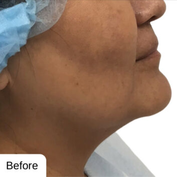 Before and After HD LipoX® of Jawline at Face Works Plastic Surgery, Plastic Surgeon Near Me in Schaumburg, IL Before and After HD LipoX® of Jawline at Face Works Plastic Surgery, Plastic Surgeon Near Me in Schaumburg, IL