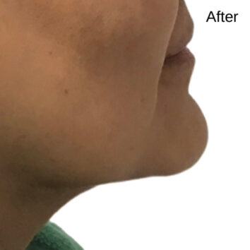 Before and After HD LipoX® of Jawline at Face Works Plastic Surgery, Plastic Surgeon Near Me in Schaumburg, IL Before and After HD LipoX® of Jawline at Face Works Plastic Surgery, Plastic Surgeon Near Me in Schaumburg, IL