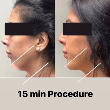 Before and After HD LipoX® of Jawline at Face Works Plastic Surgery, Plastic Surgeon Near Me in Schaumburg, IL Before and After HD LipoX® of Jawline at Face Works Plastic Surgery, Plastic Surgeon Near Me in Schaumburg, IL