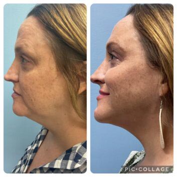 Before and After HD LipoX® of Jawline at Face Works Plastic Surgery, Plastic Surgeon Near Me in Schaumburg, IL Before and After HD LipoX® of Jawline at Face Works Plastic Surgery, Plastic Surgeon Near Me in Schaumburg, IL