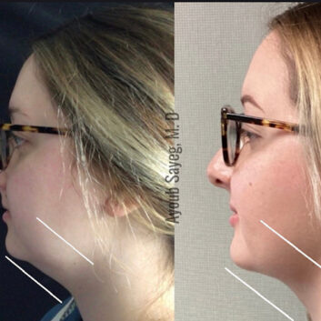 Before and After HD LipoX® of Jawline at Face Works Plastic Surgery, Plastic Surgeon Near Me in Schaumburg, IL Before and After HD LipoX® of Jawline at Face Works Plastic Surgery, Plastic Surgeon Near Me in Schaumburg, IL