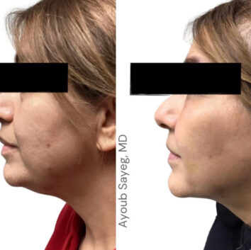 Before and After HD LipoX® of Jawline at Face Works Plastic Surgery, Plastic Surgeon Near Me in Schaumburg, IL Before and After HD LipoX® of Jawline at Face Works Plastic Surgery, Plastic Surgeon Near Me in Schaumburg, IL