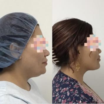 Before and After HD LipoX® of Jawline at Face Works Plastic Surgery, Plastic Surgeon Near Me in Schaumburg, IL Before and After HD LipoX® of Jawline at Face Works Plastic Surgery, Plastic Surgeon Near Me in Schaumburg, IL