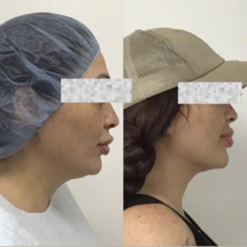 Before and After HD LipoX® of Jawline at Face Works Plastic Surgery, Plastic Surgeon Near Me in Schaumburg, IL Before and After HD LipoX® of Jawline at Face Works Plastic Surgery, Plastic Surgeon Near Me in Schaumburg, IL