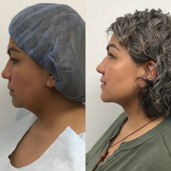 Before and After HD LipoX® of Jawline at Face Works Plastic Surgery, Plastic Surgeon Near Me in Schaumburg, IL Before and After HD LipoX® of Jawline at Face Works Plastic Surgery, Plastic Surgeon Near Me in Schaumburg, IL