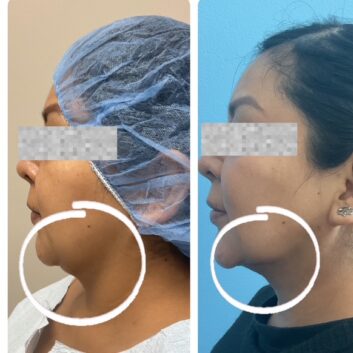 Before and After HD LipoX® of Jawline at Face Works Plastic Surgery, Plastic Surgeon Near Me in Schaumburg, IL Before and After HD LipoX® of Jawline at Face Works Plastic Surgery, Plastic Surgeon Near Me in Schaumburg, IL