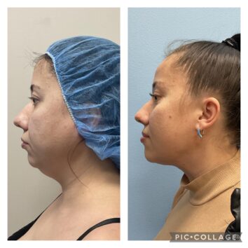 Before and After HD LipoX® of Jawline at Face Works Plastic Surgery, Plastic Surgeon Near Me in Schaumburg, IL Before and After HD LipoX® of Jawline at Face Works Plastic Surgery, Plastic Surgeon Near Me in Schaumburg, IL