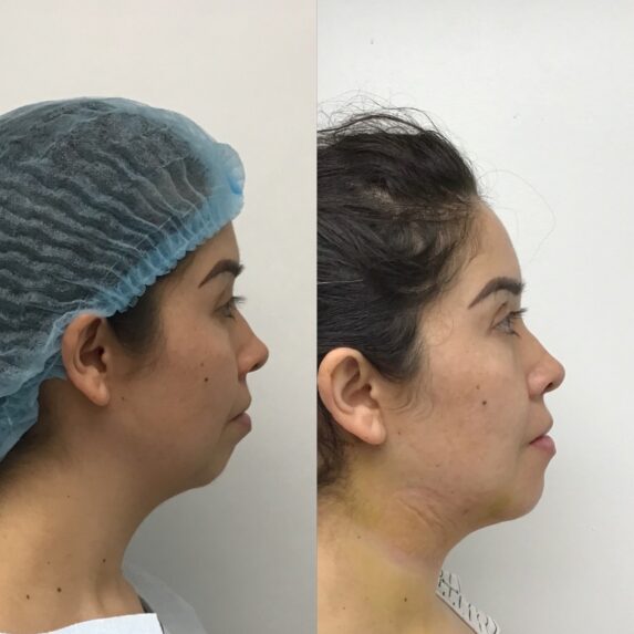 Facial Plastic Surgery Before and After at Face Works Plastic Surgery in Schaumburg, IL Facial Plastic Surgery Before and After at Face Works Plastic Surgery in Schaumburg, IL