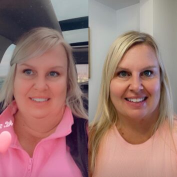 Before and After HD LipoX® of Jawline at Face Works Plastic Surgery, Plastic Surgeon Near Me in Schaumburg, IL Before and After HD LipoX® of Jawline at Face Works Plastic Surgery, Plastic Surgeon Near Me in Schaumburg, IL