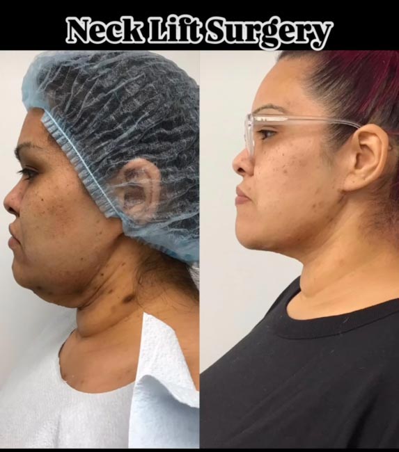 Facial Plastic Surgery Before and After at Face Works Plastic Surgery in Schaumburg, IL Facial Plastic Surgery Before and After at Face Works Plastic Surgery in Schaumburg, IL
