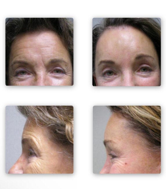 Before and After Endoscopic Brow Lift at Face Works Plastic Surgery, Near Me in Schaumburg, IL