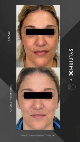 Sylfirm RF Microneedling Specialist Serving Chicago, Schaumburg, IL Sylfirm RF Microneedling Specialist Serving Chicago, Schaumburg, IL