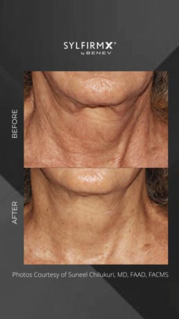 Sylfirm RF Microneedling Specialist Serving Chicago, Schaumburg, IL Sylfirm RF Microneedling Specialist Serving Chicago, Schaumburg, IL