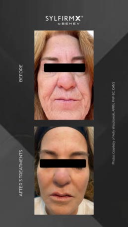 Sylfirm RF Microneedling Specialist Serving Chicago, Schaumburg, IL Sylfirm RF Microneedling Specialist Serving Chicago, Schaumburg, IL