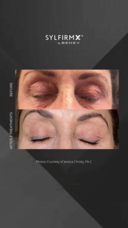 Sylfirm RF Microneedling Specialist Serving Chicago, Schaumburg, IL Sylfirm RF Microneedling Specialist Serving Chicago, Schaumburg, IL