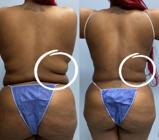 Before and After Body Liposuction at Face Works Plastic Surgery, Near Me in Schaumburg, IL