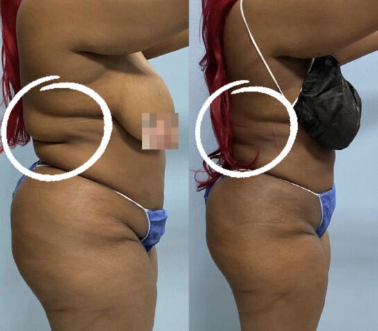 Before and After Body Liposuction at Face Works Plastic Surgery, Near Me in Schaumburg, IL