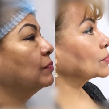 Before and After HD LipoX® of Jawline at Face Works Plastic Surgery, Plastic Surgeon Near Me in Schaumburg, IL Before and After HD LipoX® of Jawline at Face Works Plastic Surgery, Plastic Surgeon Near Me in Schaumburg, IL