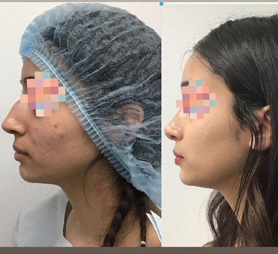 Before and After Nose Plastic Surgery at Face Works Plastic Surgery, Near Me in Schaumburg, IL