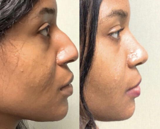 Before and After Nose Plastic Surgery at Face Works Plastic Surgery, Near Me in Schaumburg, IL