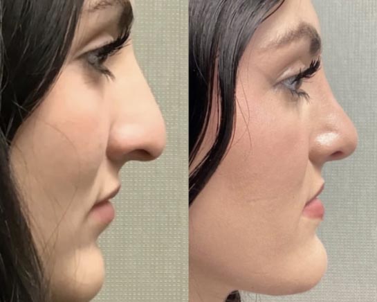 Before and After Nose Plastic Surgery at Face Works Plastic Surgery, Near Me in Schaumburg, IL