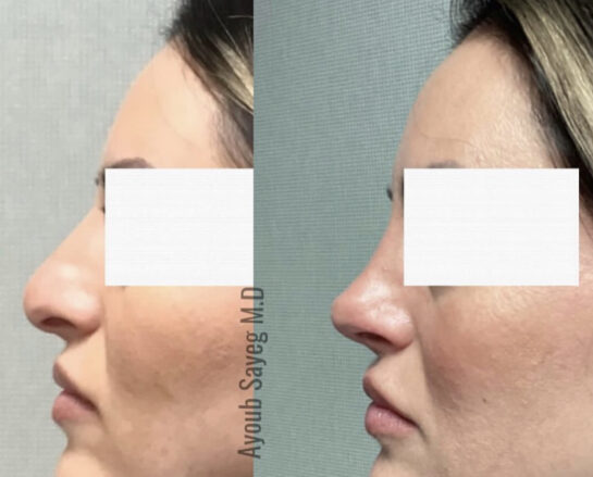 Before and After Nose Plastic Surgery at Face Works Plastic Surgery, Near Me in Schaumburg, IL
