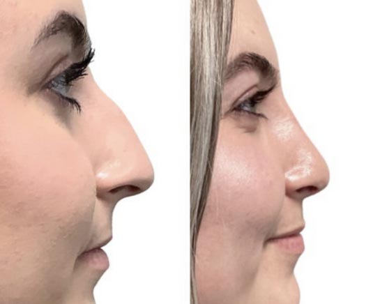 Before and After Nose Plastic Surgery at Face Works Plastic Surgery, Near Me in Schaumburg, IL