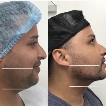 Before and After HD LipoX® of Jawline at Face Works Plastic Surgery, Plastic Surgeon Near Me in Schaumburg, IL Before and After HD LipoX® of Jawline at Face Works Plastic Surgery, Plastic Surgeon Near Me in Schaumburg, IL