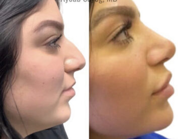 Before and After Nose Plastic Surgery at Face Works Plastic Surgery, Near Me in Schaumburg, IL