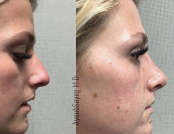Before and After Nose Plastic Surgery at Face Works Plastic Surgery, Near Me in Schaumburg, IL