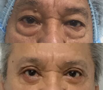 Before and After Eyelids Plastic Surgery at Face Works Plastic Surgery, Near Me in Schaumburg, IL