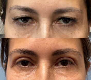Before and After Eyelids Plastic Surgery at Face Works Plastic Surgery, Near Me in Schaumburg, IL