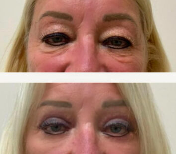 Before and After Eyelids Plastic Surgery at Face Works Plastic Surgery, Near Me in Schaumburg, IL