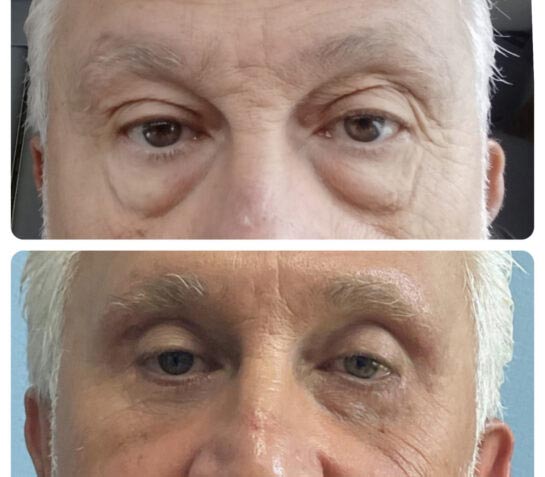 Eyelids Plastic Surgery at Face Works Plastic Surgery, Plastic Surgeon Near Me in Schaumburg, IL Eyelids Plastic Surgery at Face Works Plastic Surgery, Plastic Surgeon Near Me in Schaumburg, IL