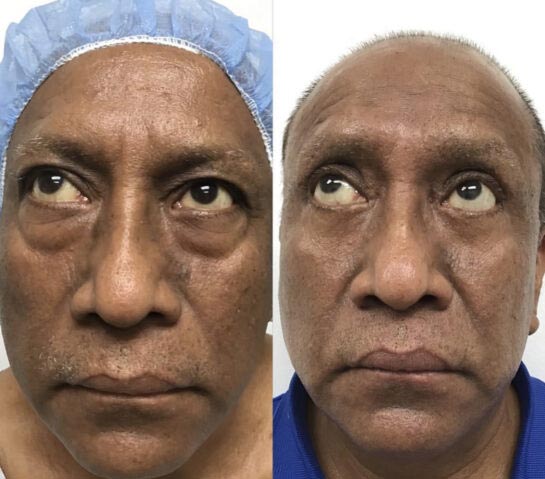 Before and After Eyelids Plastic Surgery at Face Works Plastic Surgery, Near Me in Schaumburg, IL