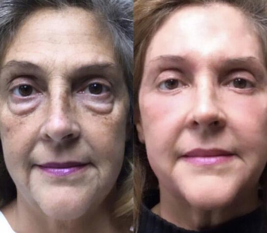 Eyelids Plastic Surgery at Face Works Plastic Surgery, Plastic Surgeon Near Me in Schaumburg, IL Eyelids Plastic Surgery at Face Works Plastic Surgery, Plastic Surgeon Near Me in Schaumburg, IL