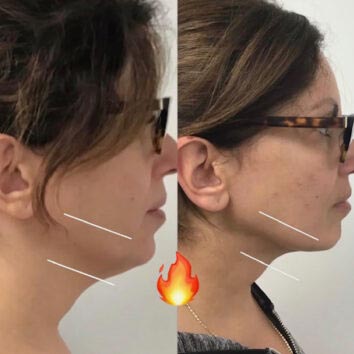 Before and After HD LipoX® of Jawline at Face Works Plastic Surgery, Plastic Surgeon Near Me in Schaumburg, IL Before and After HD LipoX® of Jawline at Face Works Plastic Surgery, Plastic Surgeon Near Me in Schaumburg, IL