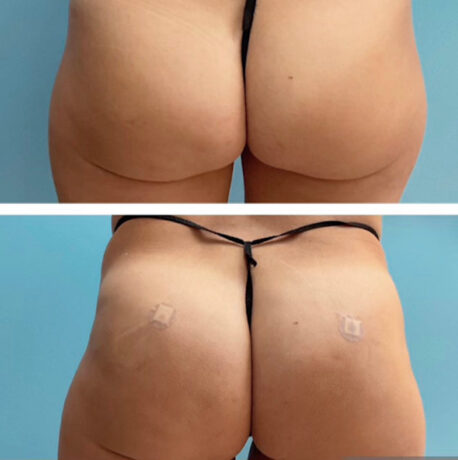 Before and After Brazilian Butt Lift ( Fat Transfer or Liquid) at Face Works Plastic Surgery, Plastic Surgeon Near Me in Schaumburg, IL