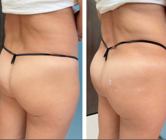Before and After Brazilian Butt Lift ( Fat Transfer or Liquid) at Face Works Plastic Surgery, Plastic Surgeon Near Me in Schaumburg, IL