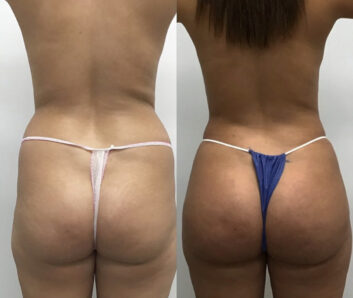 Before and After Liquid Butt Lift at Face Works Plastic Surgery, Plastic Surgeon Near Me in Schaumburg, IL Before and After Liquid Butt Lift at Face Works Plastic Surgery, Plastic Surgeon Near Me in Schaumburg, IL