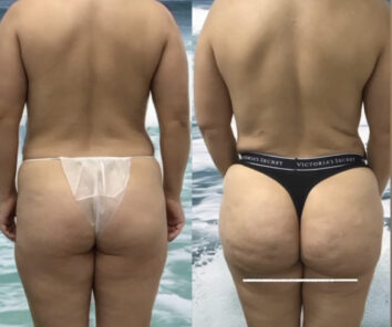 Before and After Brazilian Butt Lift ( Fat Transfer or Liquid) at Face Works Plastic Surgery, Plastic Surgeon Near Me in Schaumburg, IL
